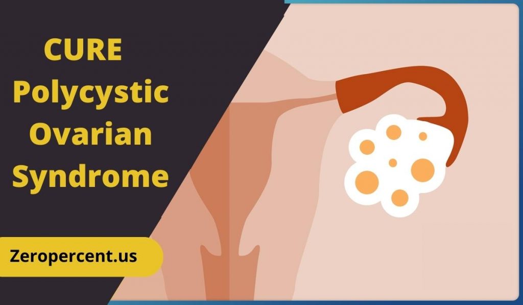 How to Cure PCOS Permanently?