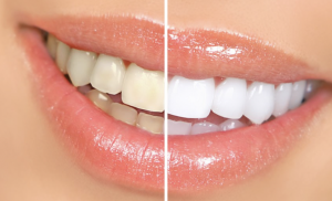 Veneers is the next big thing for Yellowed or Stained Teeth